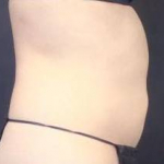 CoolSculpting<sup>®</sup> Before and After Case 7 After