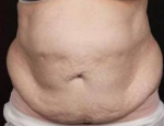 CoolSculpting<sup>®</sup> Before and After Case 8 Before