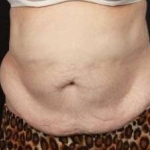 CoolSculpting<sup>®</sup> Before and After Case 8 After