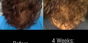 Hair Restoration (2 Treatment Exosomes) Case-8 