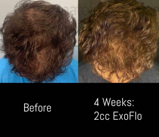 Hair Restoration (2 Treatment Exosomes) Case-8 