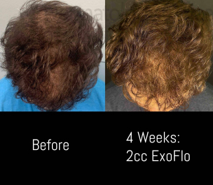 Exoflo Hair Restoration (2 Syringes) Case 9 