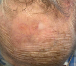 SRT-100 Radiation Before and After Case-109 After