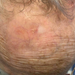 SRT-100 Radiation Before and After Case-109 After