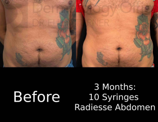 Radiesse Before And After 14 