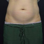 CoolSculpting<sup>®</sup> Before and After Case 9 Before