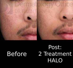 HALO (2 Treatment) Case 1 