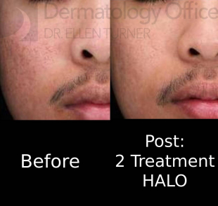 Halo (2 Treatment) Case-5 