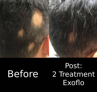 Hair Loss (2 Treatments ExoFlo) Case-6 