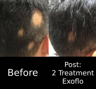 Hair Loss Before and After Case 1 