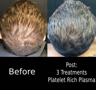 Platelet-Rich Plasma (3 Treatment) Case-4 