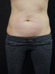 CoolSculpting<sup>®</sup> Before and After Case 9 After