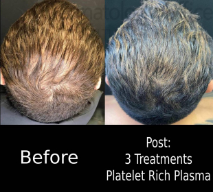 Hair Loss (3 Treatment PRP) Case-9 