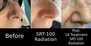 SRT-100 Radiation (18 Treatment) Case 111 