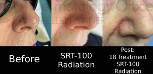 Skin Cancer (18 Treatments Radiation) Case-35 