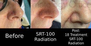 Skin Cancer (18 Treatments Radiation) Case-35 