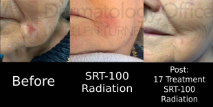 Skin Cancer (17 Treatments Radiation) Case-36 