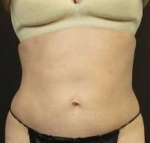 CoolSculpting<sup>®</sup> Before and After Case 10 After