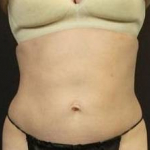 CoolSculpting<sup>®</sup> Before and After Case 10 After