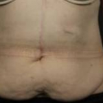 CoolSculpting<sup>®</sup> Before and After Case 11 Before