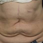 CoolSculpting<sup>®</sup> Before and After Case 11 After