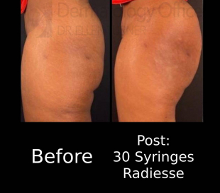 Radiesse Butt Augmentation (30 Syringes) Case 1 