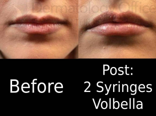 Volbella (2 Syringes) Case 1 