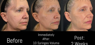 Voluma (10 Syringes) Case-4 