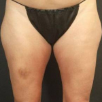 CoolSculpting<sup>®</sup> Before and After Case 12 Before