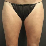 CoolSculpting<sup>®</sup> Before and After Case 12 After