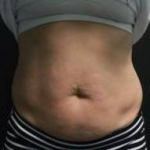 CoolSculpting<sup>®</sup> Before and After Case 13 Before