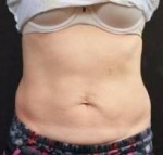 CoolSculpting<sup>®</sup> Before and After Case 13 After
