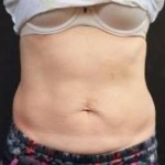 CoolSculpting<sup>®</sup> Before and After Case 13 After