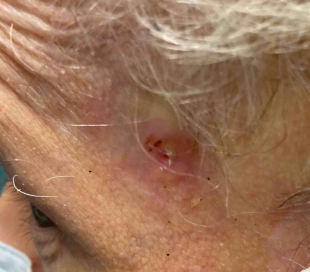 Skin Cancer Before and After Case-34 
