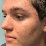 Acne (5 Month Accutane) Case 18 Before