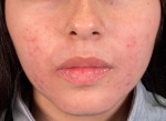 Acne (6 Weeks Spironolactone) Case-19 After