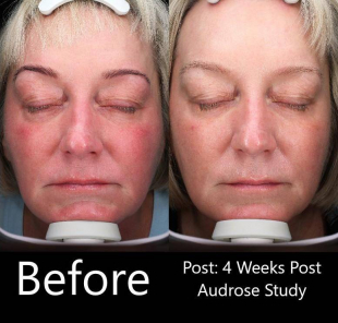 Audrose Beauty (1 Month) Case-2 