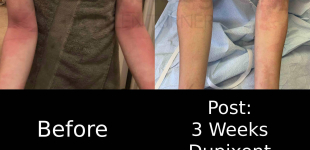 Eczema/ Atopic Dermatitis (3 Weeks Dupixent) Case-21 