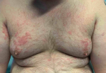 Allergic Contact Dermatitis Case-6 Before