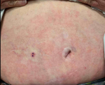 Allergic Contact Dermatitis Case-9 Before
