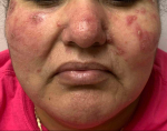 Allergic Contact Dermatitis Case-11 Before