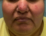 Allergic Contact Dermatitis Case-11 After