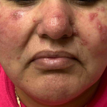 Eczema/ Atopic Dermatitis Case-24 Before