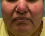 Eczema/ Atopic Dermatitis Case-24 After