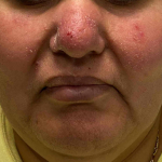 Eczema/ Atopic Dermatitis Case-24 After