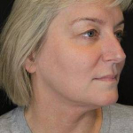 Ultherapy<sup>®</sup> Before and After Case 1 Before