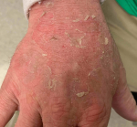 Allergic Contact Dermatitis Case-12 Before