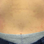 Eczema/Atopic Dermatitis Case-25 Before