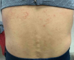 Eczema/ Atopic Dermatitis Case-26 Before