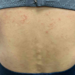 Eczema/ Atopic Dermatitis Case-26 Before
